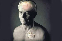 【健康解碼】起搏器真的能治好帕金森病嗎？